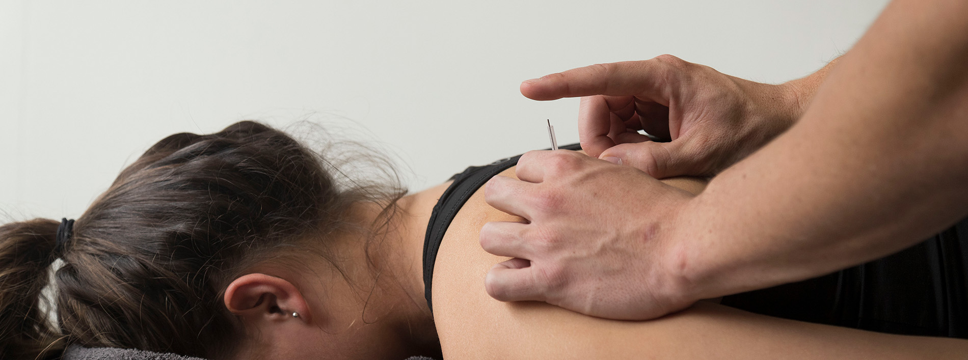Dry Needling